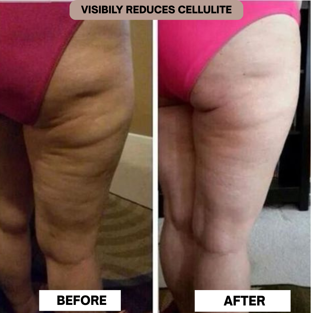 CELLULITE RELIEF BODY MASSAGER